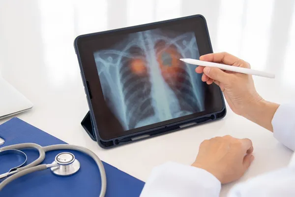 Lung Cancer