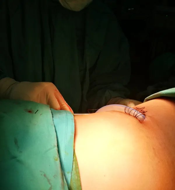 VATS Thoracic Surgery
