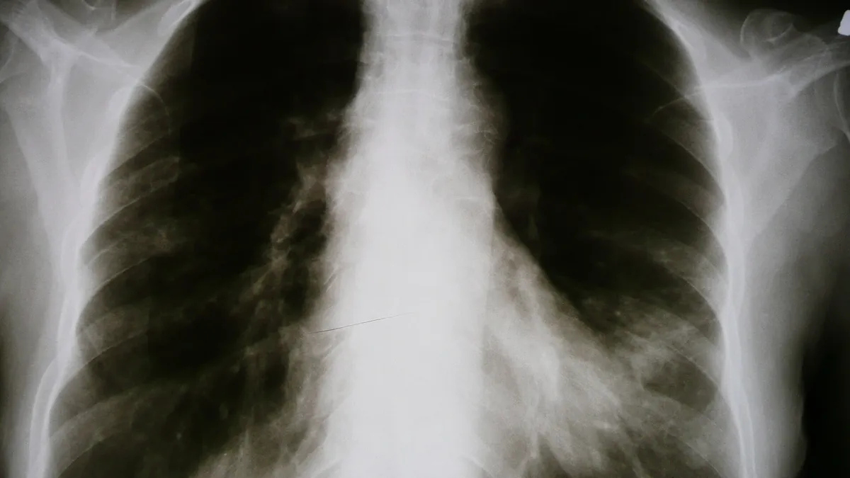 Chest X-ray showing the lungs, often the first test when lung cancer is suspected