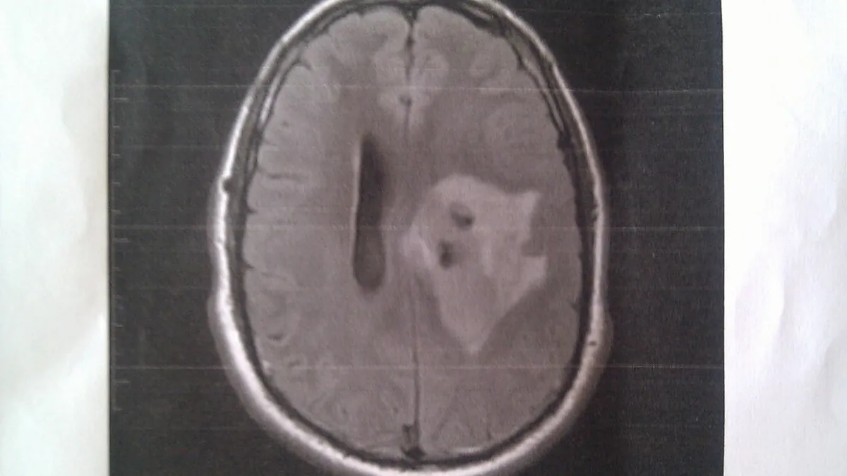 Brain MRI scan images reviewed to diagnose a brain tumor